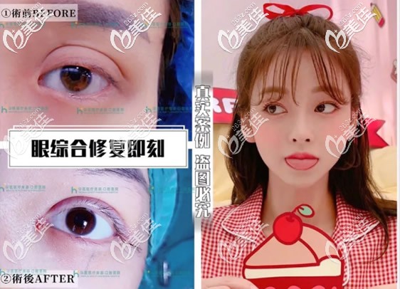 這3張圖片!是呼和浩特華醫(yī)整形王春燕院長做過的眼綜合和雙眼皮修復案例中比較經典的！