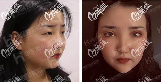 真人重瞼切開、開內(nèi)眥、提肌矯正15天效果