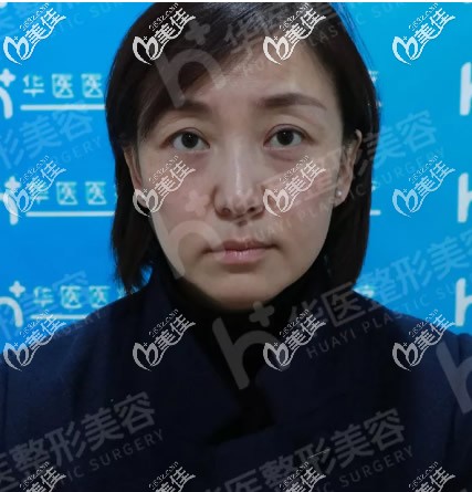 呼和浩特華醫(yī)整形面部埋線提升前 呼和浩特華醫(yī)整形面部埋線提升前