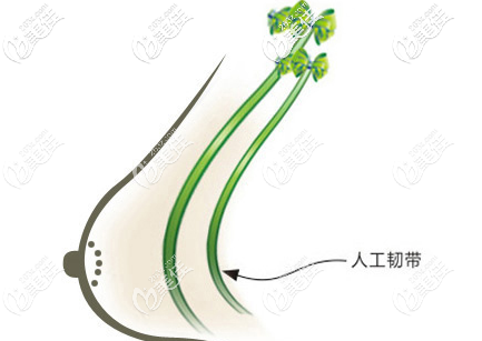 人工韌帶提升手術(shù)