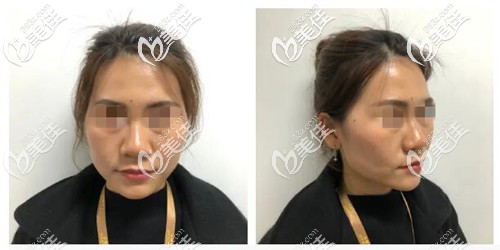 面部脂肪填充手術(shù)前 面部脂肪填充手術(shù)前