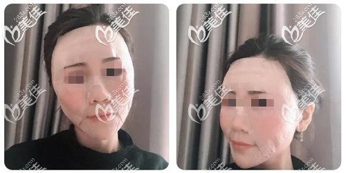 面部脂肪填充手術(shù)后當(dāng)天 面部脂肪填充手術(shù)后當(dāng)天