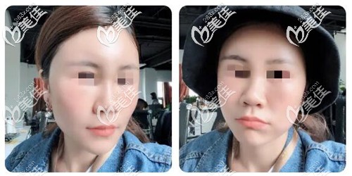 面部脂肪填充第三天恢復(fù)照片 面部脂肪填充第三天恢復(fù)照片