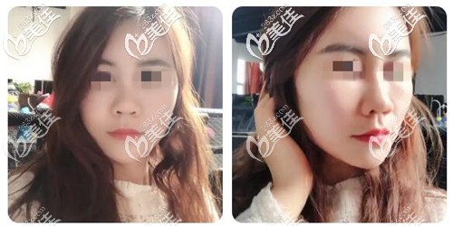 面部脂肪填充15天恢復(fù)照片 面部脂肪填充15天恢復(fù)照片