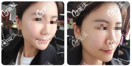 脂肪填充術(shù)后3個(gè)月的恢復(fù)效果 脂肪填充術(shù)后3個(gè)月的恢復(fù)效果