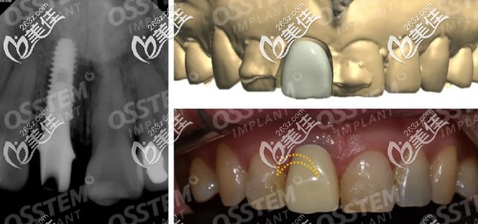 萬萬沒想到女朋友門牙是假的，她曾在成都極光口腔做了韓國奧齒泰即刻種植牙…