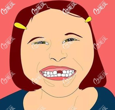 上門牙缺失真的好丑呀 上門牙缺失真的好丑呀