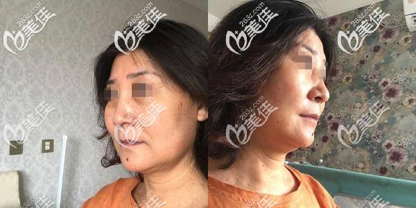 剛做完埋線提升術(shù)后腫脹，面部僵硬