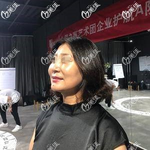 優(yōu)雅斯埋線提升術(shù)后五天效果