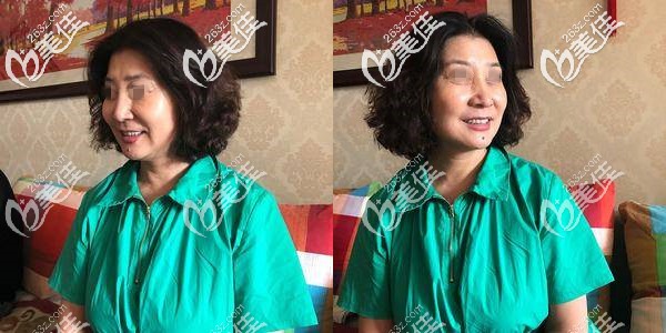 拿到這份蘇州埋線提升價(jià)格后給你們看看我一邊臉4根優(yōu)雅斯大v線的效果