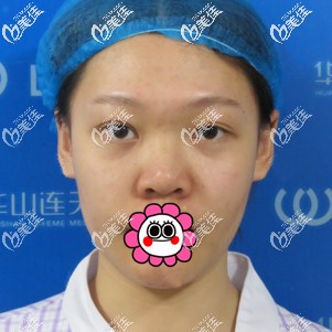 做肋軟骨隆鼻前 做肋軟骨隆鼻前