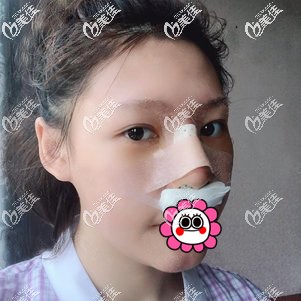 肋軟骨隆鼻術(shù)后恢復(fù)三天 肋軟骨隆鼻術(shù)后恢復(fù)三天