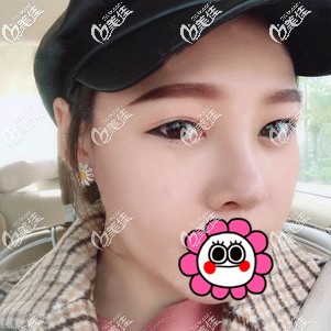 肋軟骨隆鼻恢復(fù)20天效果 肋軟骨隆鼻恢復(fù)20天效果