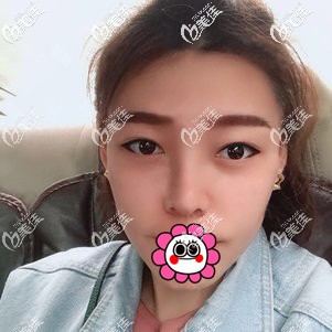 花了小兩萬用肋軟骨做了日系自然風隆鼻恢復后面部很和諧效果很滿意