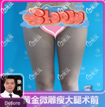 青島華顏美術(shù)前大腿吸脂的樣子 青島華顏美術(shù)前大腿吸脂的樣子