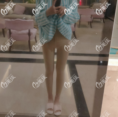 青島華顏美術(shù)前大腿吸脂術(shù)后第二天的時候 青島華顏美術(shù)前大腿吸脂術(shù)后第二天的時候