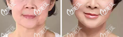 <!--<i data=20240703-sp></i>-->薛欣醫(yī)生除皺案例 <!--<i data=20240703-sp></i>-->薛欣醫(yī)生除皺案例