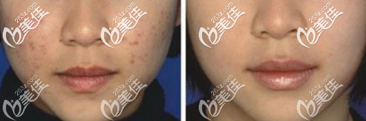 <!--<i data=20240703-sp></i>-->薛欣醫(yī)生激光祛痘案例 <!--<i data=20240703-sp></i>-->薛欣醫(yī)生激光祛痘案例