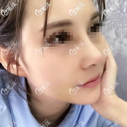 肋骨鼻綜合第7天拍照效果 肋骨鼻綜合第7天拍照效果