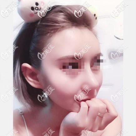 鼻綜合15天恢復(fù)效果圖片 鼻綜合15天恢復(fù)效果圖片