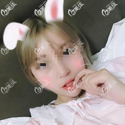 本人找武漢匠星雷云飛院長做肋軟骨鼻綜合變美日記!看完讓你少走彎路！