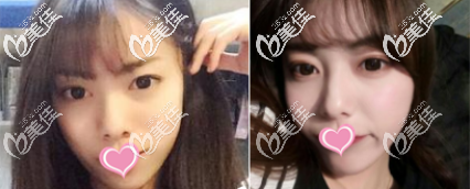 <!--<i data=20240703-sp></i>--><!--<i data=20240703-sp></i>-->庭切開雙眼皮案例 <!--<i data=20240703-sp></i>--><!--<i data=20240703-sp></i>-->庭切開雙眼皮案例