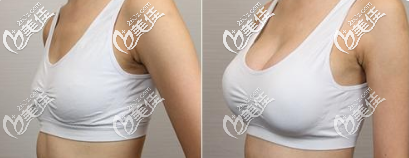 <!--<i data=20240703-sp></i>--><!--<i data=20240703-sp></i>-->庭自體脂肪豐胸案例 <!--<i data=20240703-sp></i>--><!--<i data=20240703-sp></i>-->庭自體脂肪豐胸案例