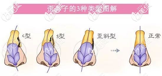 歪鼻的幾種程度