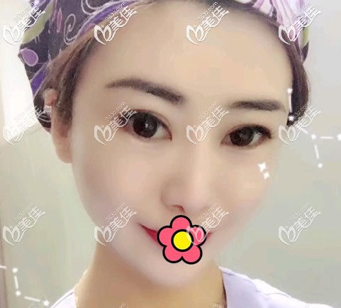 鼻頭扁平?jīng)]鼻尖能長(zhǎng)出來?別傻了!還是去做個(gè)自體肋軟骨隆鼻更靠譜一些!