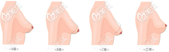 胸部下垂的程度不同