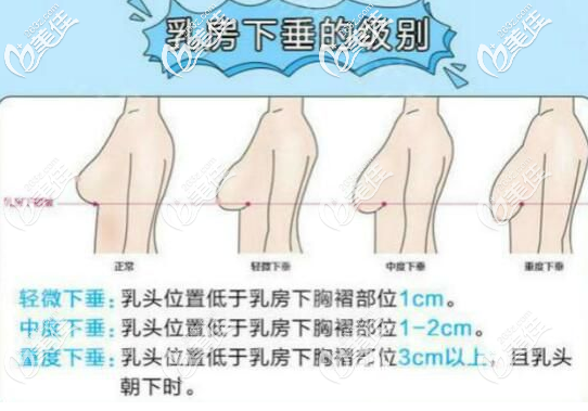 乳房下垂的情況