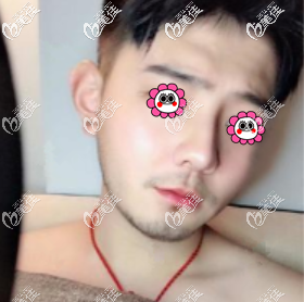 硅膠隆鼻一個月了