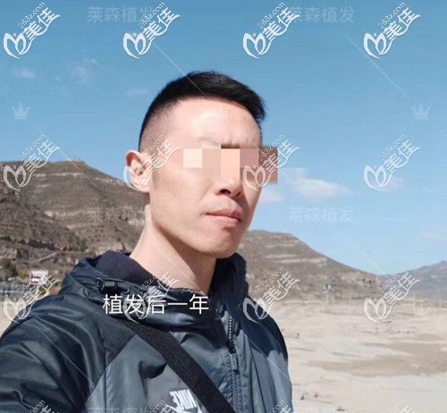 公開(kāi)2019我的真實(shí)的植發(fā)經(jīng)歷!現(xiàn)曾經(jīng)雄性激素性脫發(fā)的我已經(jīng)植發(fā)滿(mǎn)一年了!