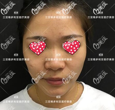 鼻整形術(shù)前照 鼻整形術(shù)前照