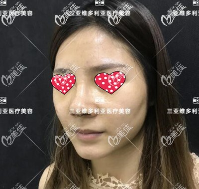 隆鼻術(shù)后一周拆線 隆鼻術(shù)后一周拆線