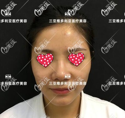 隆鼻術(shù)后15天恢復(fù)<span style= 隆鼻術(shù)后15天恢復(fù)<span style=