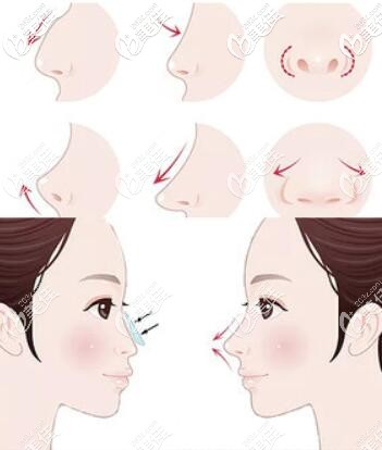 鼻部整形示意圖