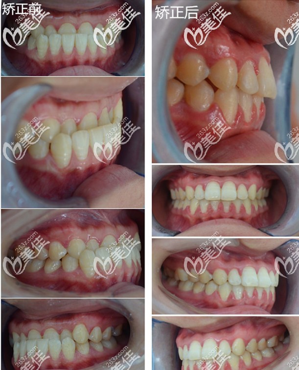 亮出骨性地包天戴牙套對比照，沒想到隱適美隱形矯正的感覺這么爽！