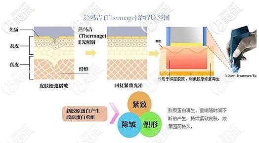 熱瑪吉的治療原理 熱瑪吉的治療原理