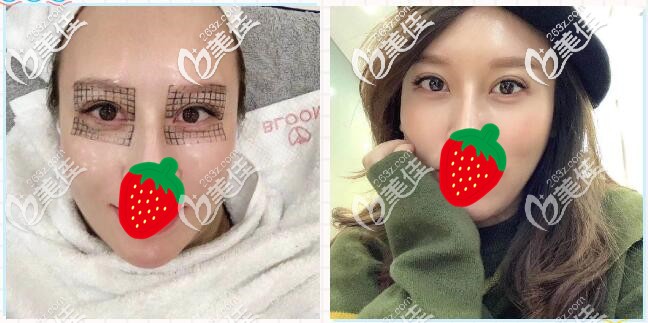 眼部熱瑪吉前后對比案例 眼部熱瑪吉前后對比案例