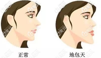 地包天和正常的臉型區(qū)別圖 地包天和正常的臉型區(qū)別圖