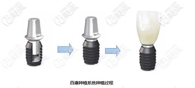 百康種植體種植優(yōu)勢(shì)