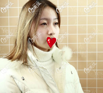 濟南藝星假體隆鼻+雙眼皮術前照片 濟南藝星假體隆鼻+雙眼皮術前照片