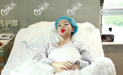 濟南藝星假體隆鼻+雙眼皮術后即刻照片 濟南藝星假體隆鼻+雙眼皮術后即刻照片