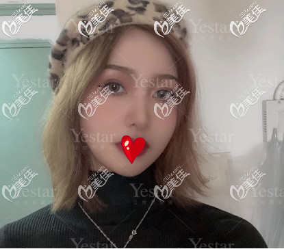 濟南藝星假體隆鼻+雙眼皮術后30天的樣子 濟南藝星假體隆鼻+雙眼皮術后30天的樣子