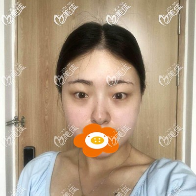 做雙眼皮手術(shù)前的我 做雙眼皮手術(shù)前的我