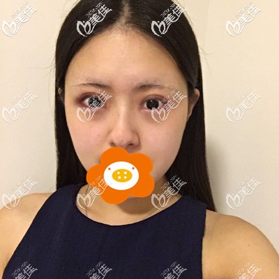 做完雙眼皮第7天還有點(diǎn)腫 做完雙眼皮第7天還有點(diǎn)腫