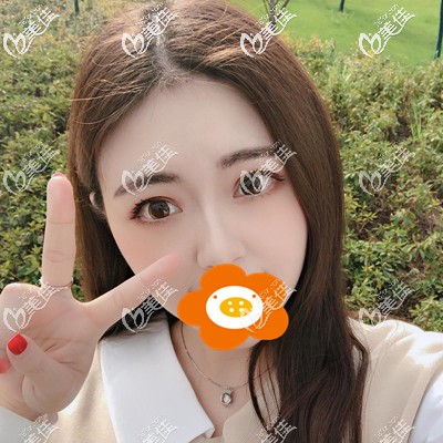 割雙眼皮1個(gè)月 割雙眼皮1個(gè)月