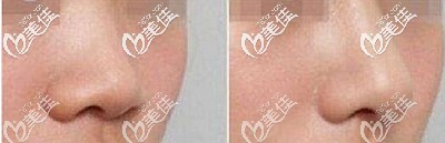 膨體隆鼻后的效果對比