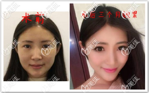 我做皮層光焊瘦臉效果對比圖